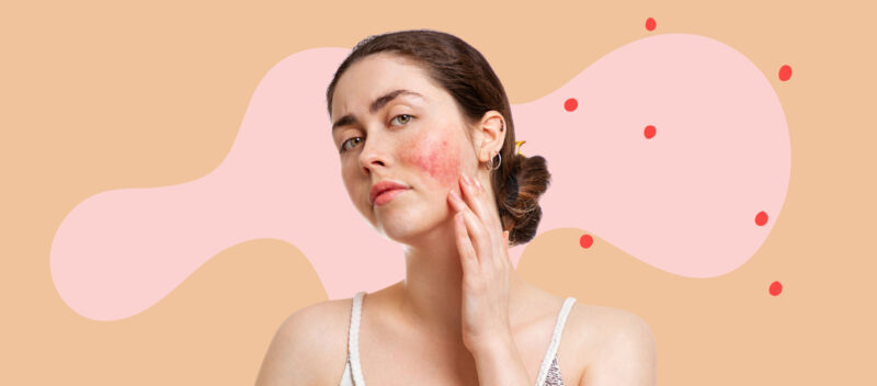 rosacea tips