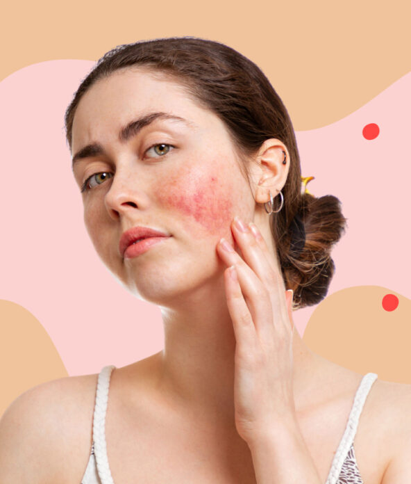 rosacea tips