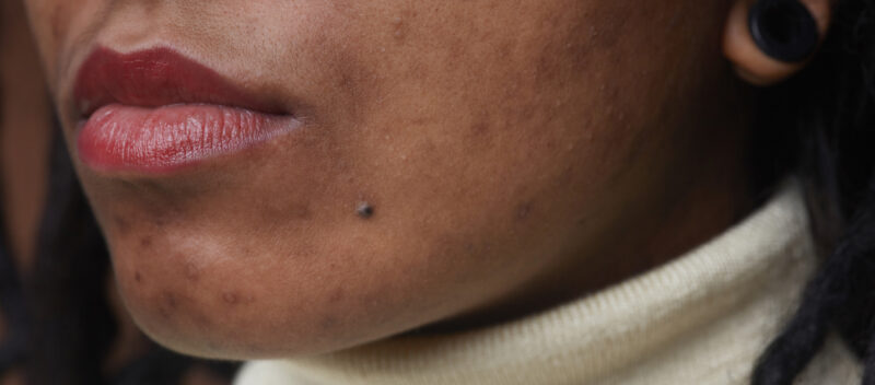 Close-up of the lower half of a person's face showing lips with red lipstick, a mole, and some skin blemishes. The person is wearing a light-colored turtleneck sweater.